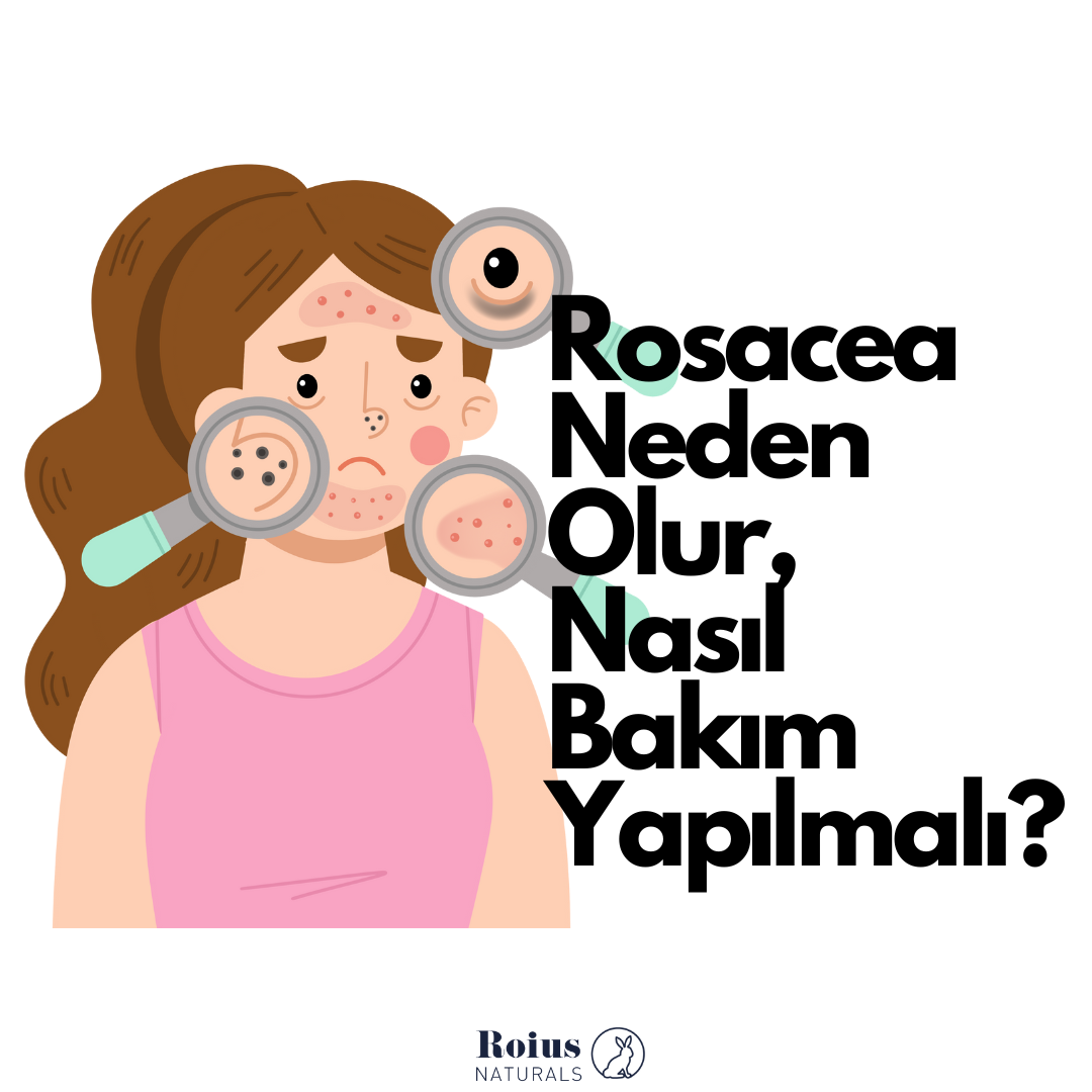 Bize Çok Sorduklarınızdan Rosacea Hastalığı İçin Önerilerimiz